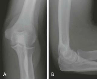 FIGURE 11–8, A and B , Anteroposterior and lateral radiographs of the elbow reveal linear lucency at the posterior aspect of the olecranon, with displacement of the anterior and posterior fat pads. There is no comminution or displacement: Mayo type I fracture.