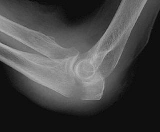 FIGURE 11–9, A lateral radiograph of the elbow reveals displacement of the anterior fat pad, with a transverse fracture through the olecranon, with diastasis: Mayo type II fracture.