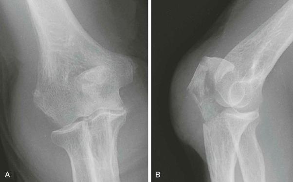 FIGURE 11–10, A and B , Anteroposterior and lateral radiographs of the elbow reveal comminuted fracture of the olecranon, with diastasis of a proximal fragment: Mayo type III fracture.