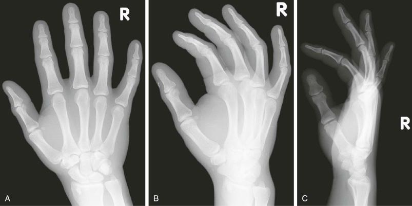 eFIGURE 16–1, Posteroanterior, oblique, and lateral radiographic views of the hand.