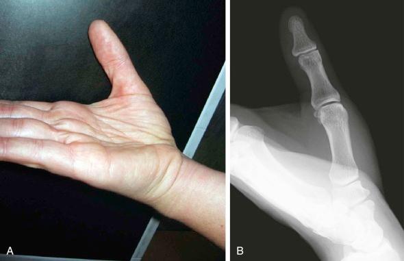 eFIGURE 16–2, Proper positioning for radiography ( A ) and anteroposterior Roberts view ( B ) of the thumb.