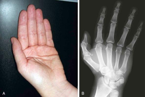 eFIGURE 16–3, Proper positioning for radiography ( A ) and Brewerton view ( B ) to evaluate the hook of the hamate and fourth and fifth metacarpophalangeal joints.