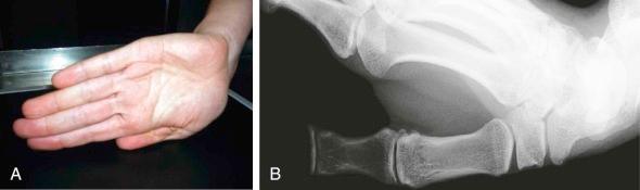 eFIGURE 16–4, Proper positioning for radiography ( A ) and Burman view ( B ) for improved visualization of the first carpometacarpal joint space.