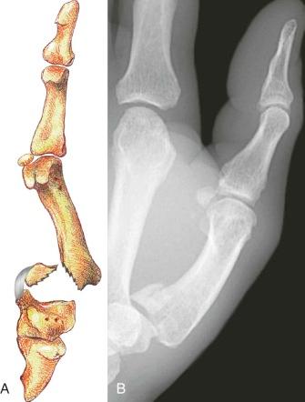 FIGURE 16–1, Bennett's fracture. Diagram ( A ) and posteroanterior radiograph ( B ) demonstrate a stable proximal volar fracture fragment with proximal and radial displacement of distal metacarpal secondary to pull of multiple tendons.