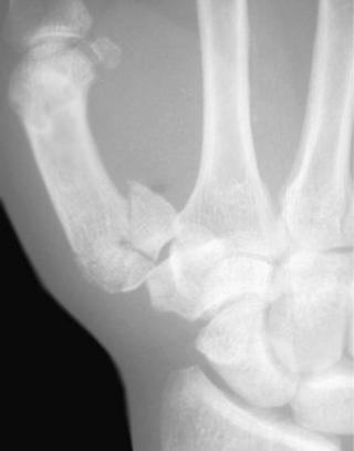FIGURE 16–2, Rolando's fracture. Posteroanterior radiograph shows comminuted intraarticular fracture at the base of the first metacarpal.