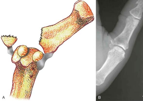 FIGURE 16–3, Skier's thumb. Avulsion of the ulnar collateral ligament. A , The diagram demonstrates a significantly displaced avulsion fragment that likely requires operative fixation. B , Posteroanterior radiograph of the thumb demonstrates a nondisplaced fracture more amenable to medical treatment.