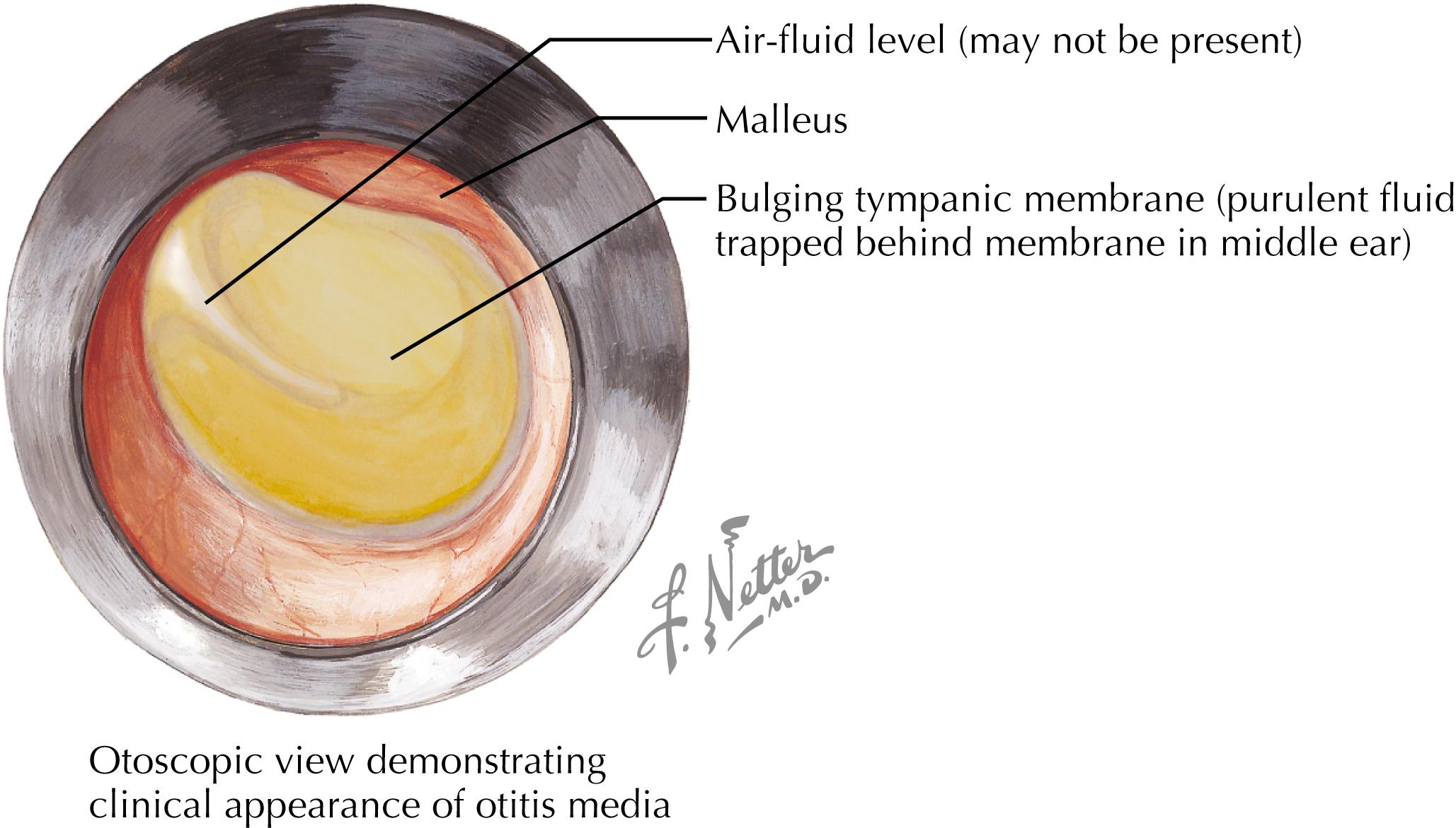 Fig. 32.3, Tympanic membranes.