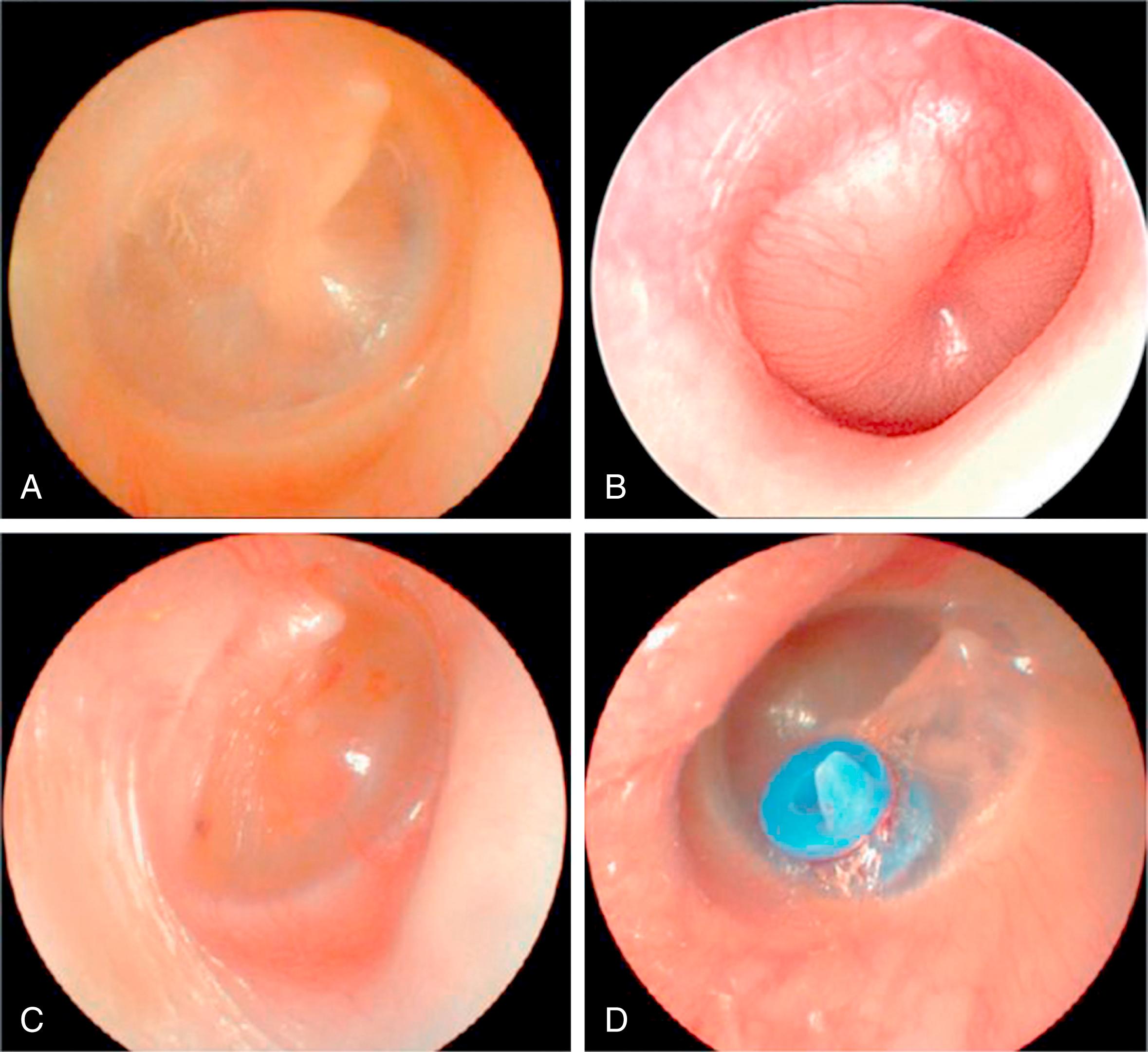 Fig. 15.1, Otoscopic images. (A) Normal appearance of tympanic membrane (TM). (B) Red and bulging TM indicative for acute otitis media. (C) TM indicative for otitis media with effusion. (D) Presence of a tympanostomy tube in the TM.