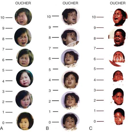 E-FIGURE 44.2, Ethnic versions of the Oucher Pain Scale. A , Asian. B , Hispanic. C , African American.