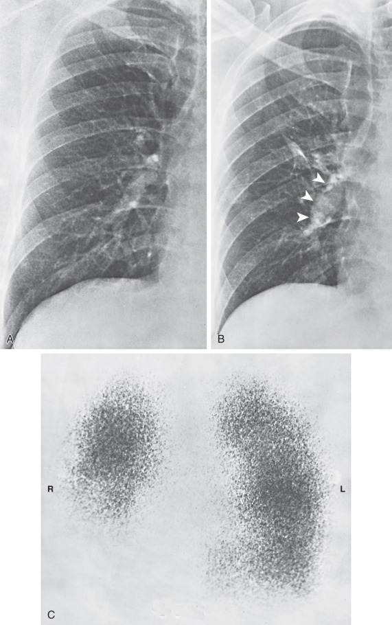 Fig. 50.1, Fleischner sign and Westermark sign in acute pulmonary embolism. On admission to the hospital, posteroanterior radiograph (A) revealed no significant abnormalities. Several days after abdominal surgery, the patient experienced abrupt onset of right-sided chest pain and dyspnea. A radiograph at this time (B) showed an obvious increase in diameter and a change in configuration of the right interlobar artery (Fleischner sign; arrowheads ); also the distal end of this artery appeared knuckled and the vessels peripheral to it diminutive. The right lower zone showed increased radiolucency, indicating diminished perfusion (Westermark sign). Scintigraphy (C) revealed absence of perfusion of the lower half of the right lung.