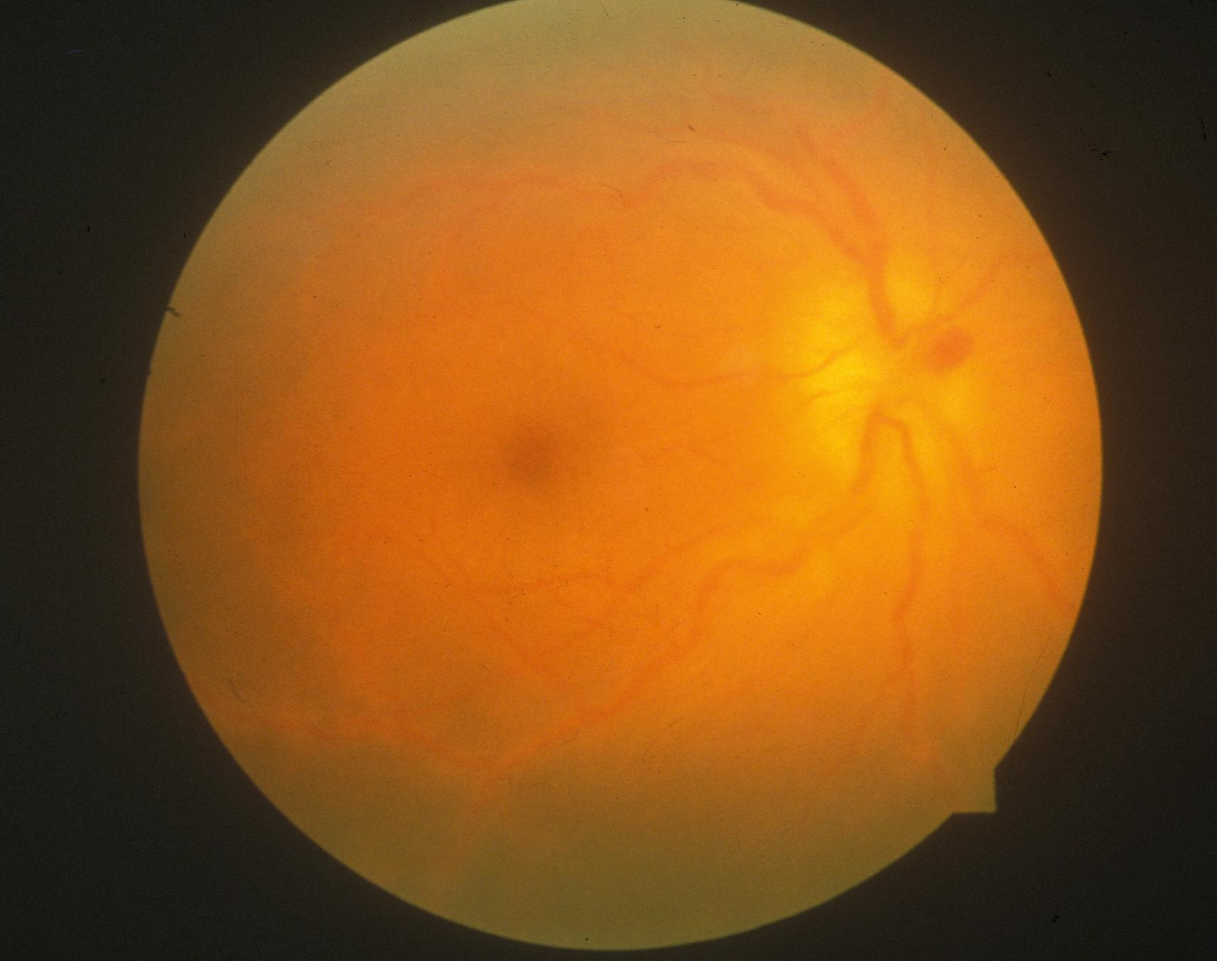 Fig. 13.3, Posterior pole of the retina 1 week after the onset of symptoms of acute retinal necrosis and after vitrectomy had been performed, demonstrating optic disk swelling and retinal perivascular sheathing.