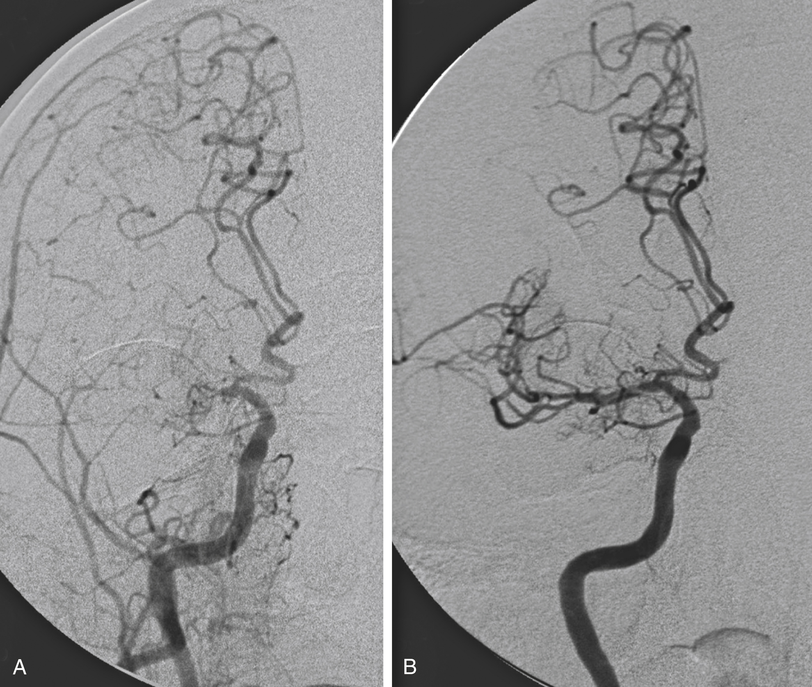 Fig. 61.1, (A) Right internal carotid artery angiogram, initial anteroposterior view, showing occlusion of the right M1 segment of the middle cerebral artery (MCA) in a 77-year-old man. (B) After mechanical thrombectomy with a stent retriever, the MCA is recanalized. Note, however, a persistent dissection flap in the MCA.