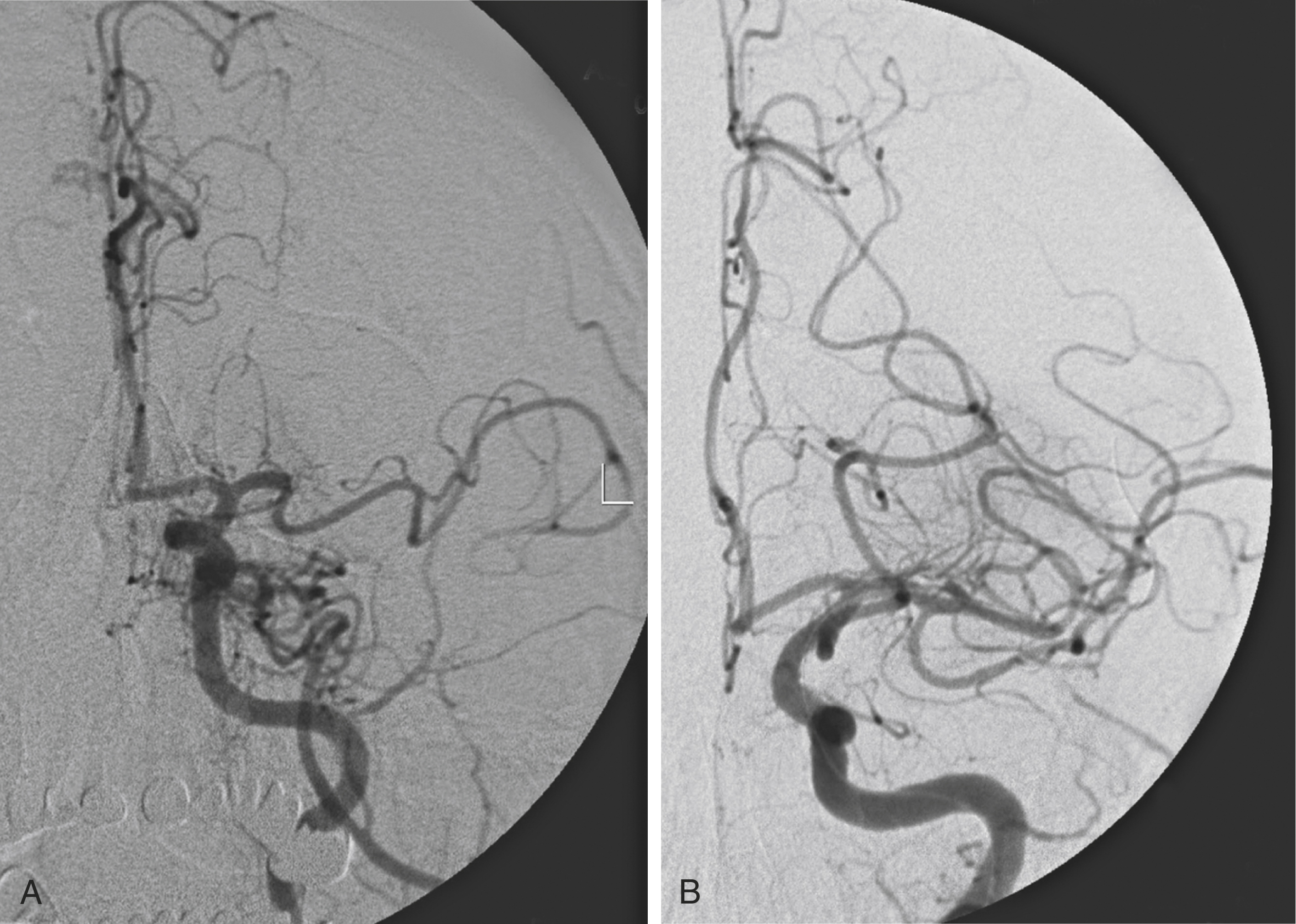 Fig. 61.2, Left internal carotid artery angiogram, anteroposterior view. (A) Occlusion of the left M1 segment of the middle cerebral artery, with poor collaterals distally. (B) Complete recanalization obtained after mechanical thrombectomy with a stent retriever.