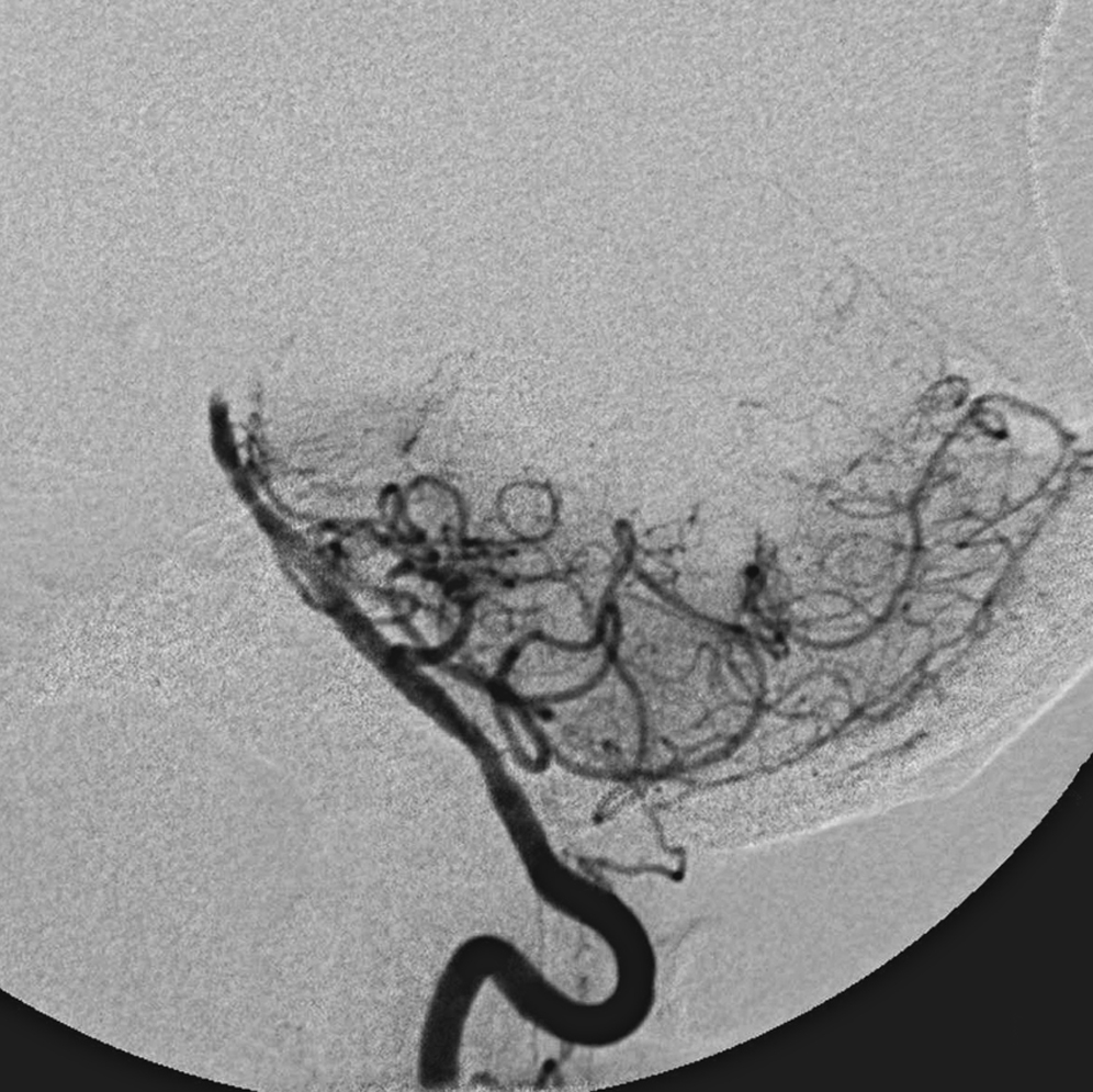 Fig. 61.3, Left vertebral artery angiogram, lateral view, showing a midbasilar occlusion.