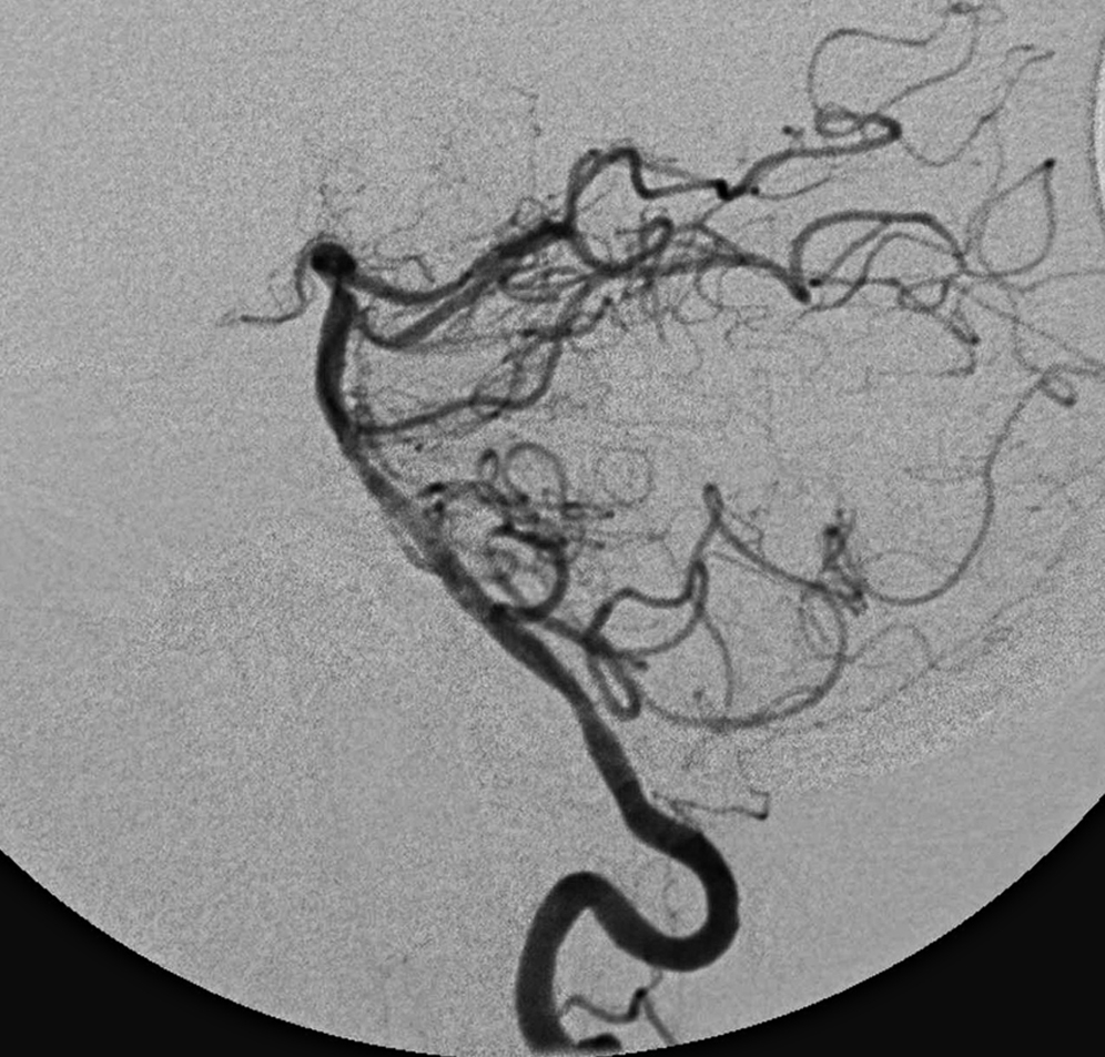 Fig. 61.4, Same view of the patient shown in 61.3, demonstrating complete recanalization of the posterior circulation after basilar thrombectomy.