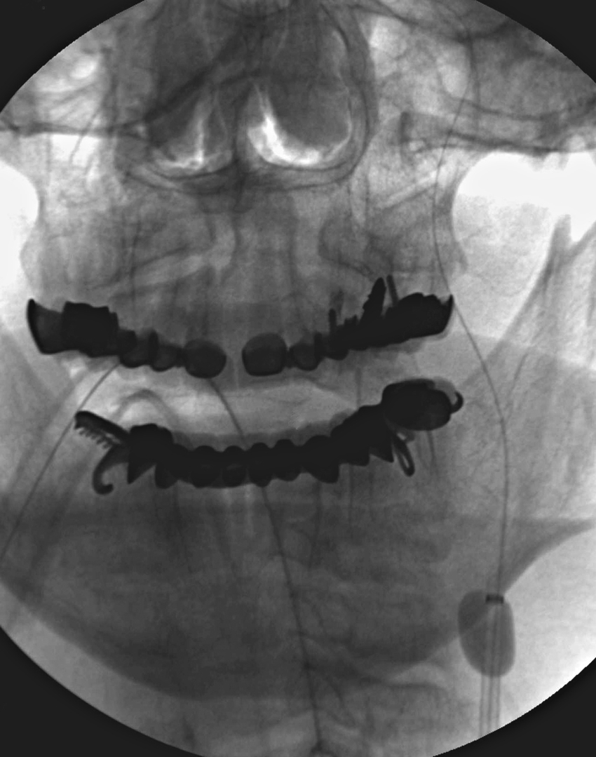 Fig. 61.5, Anteroposterior unsubtracted projection during a left middle cerebral artery thrombectomy, showing an inflated balloon guide catheter in the left internal carotid artery, creating flow arrest during clot retrieval.