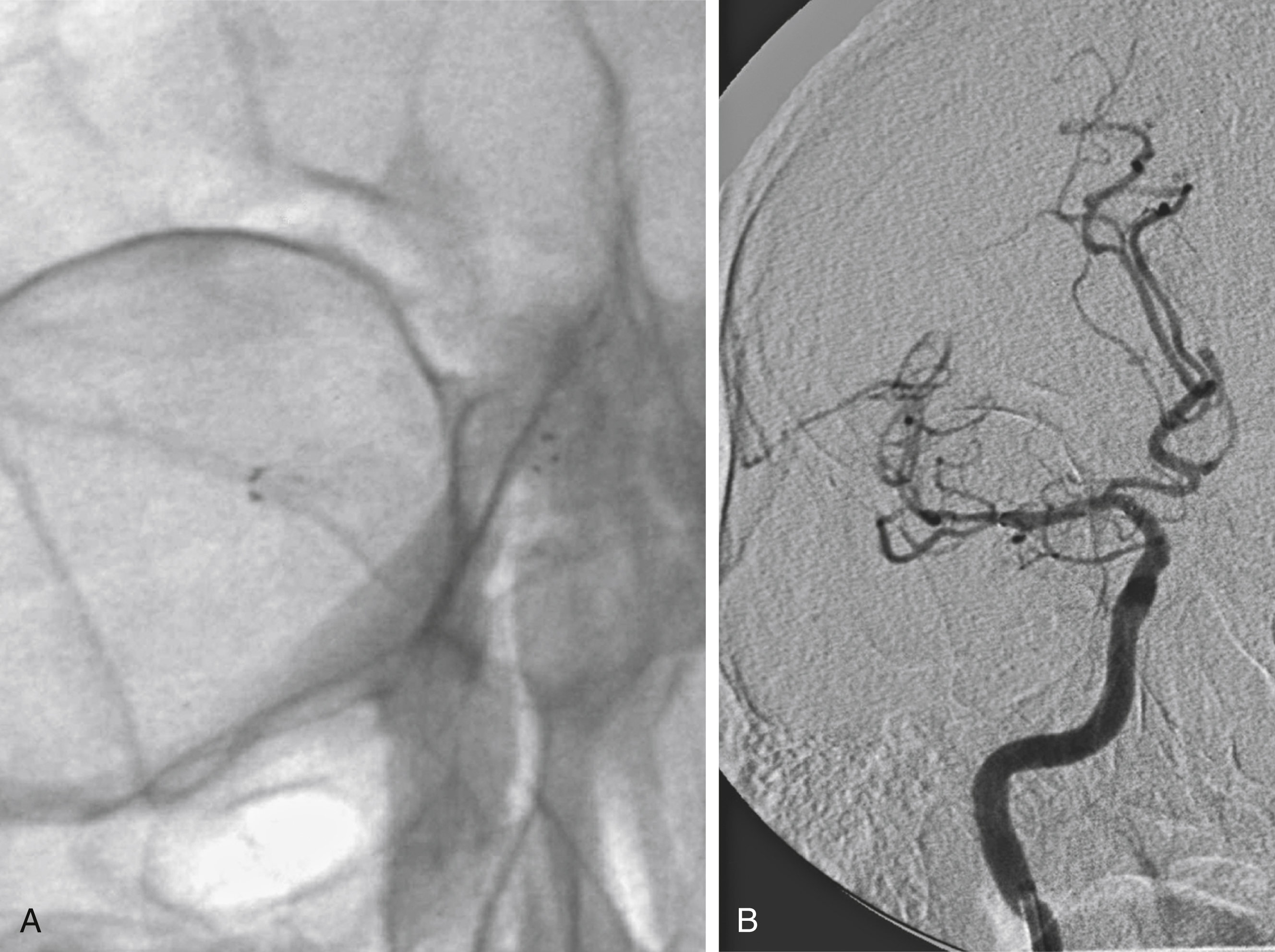 Fig. 61.9, (A) Same patient as in Fig. 61.1, showing deployment of a Neuroform stent across the dissection flap. (B) Subsequent intracranial angiogram in the same patient, demonstrating patency of the lumen after stenting.