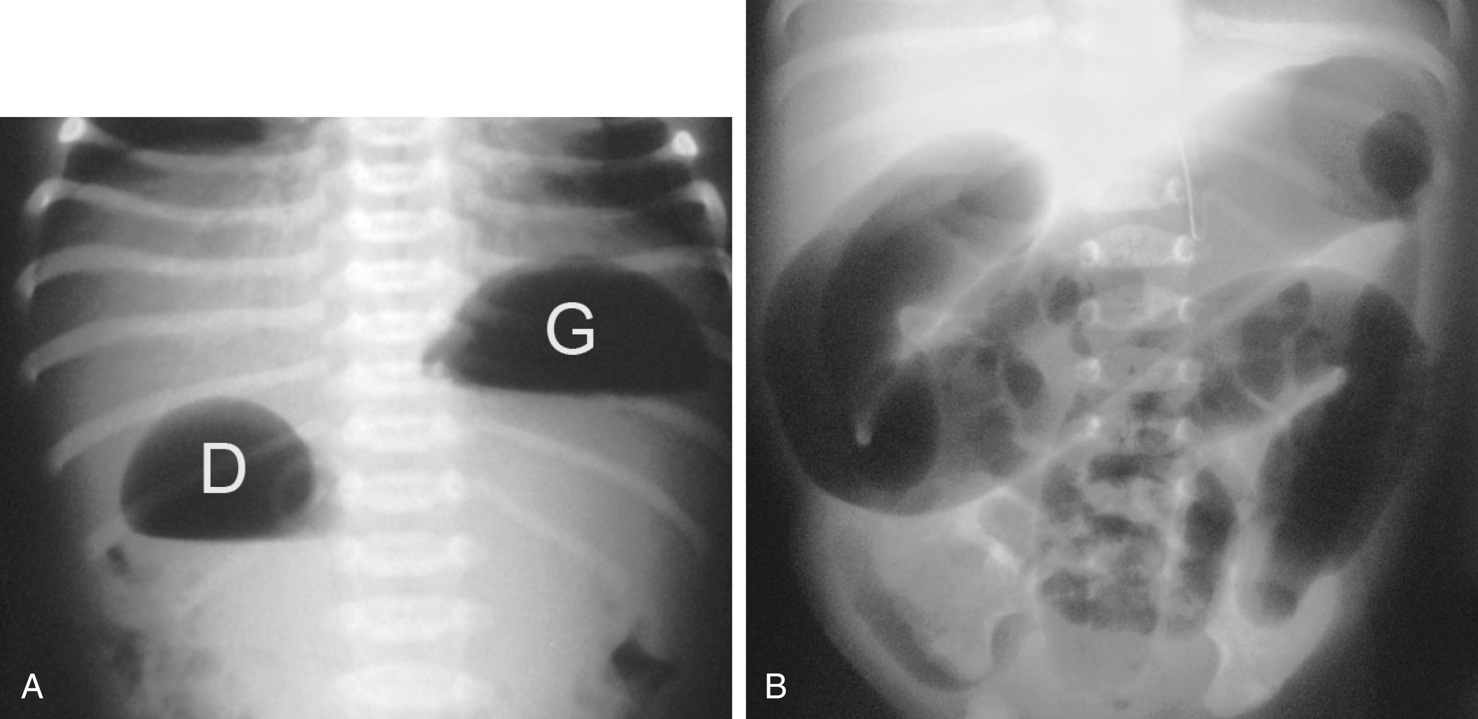 Fig. 50.1, Intestinal Obstruction.