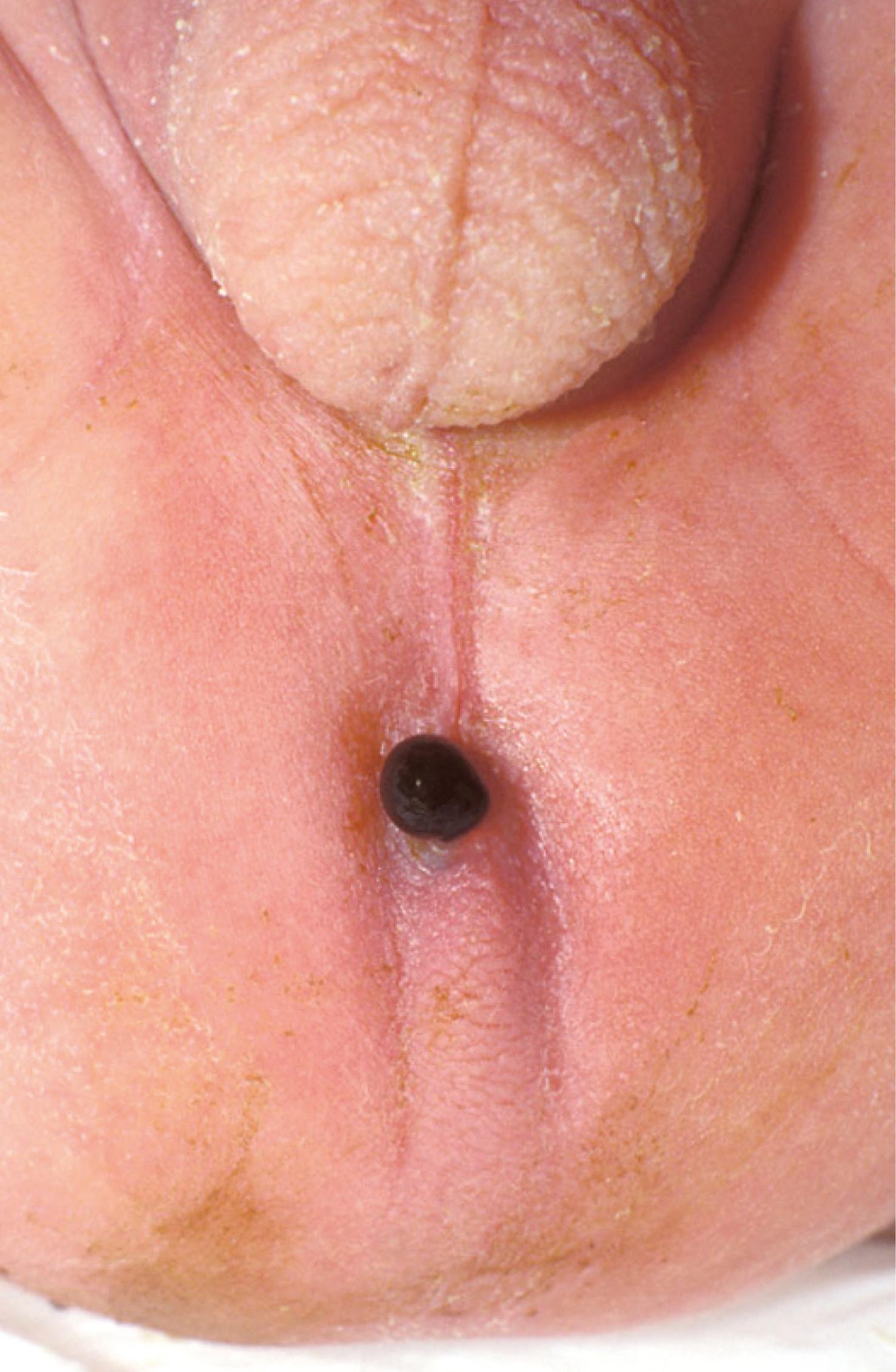 Fig. 50.5, Low Imperforate Anus.