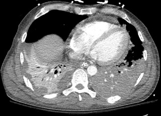 FIGURE 10.1, Right lower lobe atelectasis and left lower lobe pneumonia. Axial contrast-enhanced computed tomography shows hypoenhancing left lower lobe lung parenchyma indicating the presence of pneumonia. There is decreased volume and hyperenhancement of the right lower lobe consistent with atelectasis adjacent to pleural effusion.