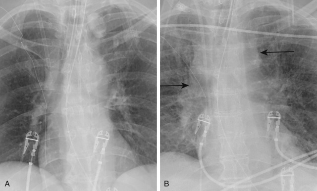 FIGURE 10.11, Fluid overload and pulmonary edema. Composite image with frontal chest radiograph before (A) and after (B) the administration of 12 L of intravenous fluids shows widening of the vascular pedicle (arrows) , enlargement of the azygous vein, and diffuse interstitial edema.