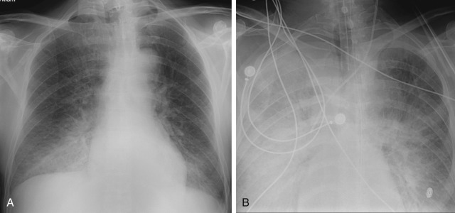 FIGURE 10.12, Diffuse alveolar damage (DAD) and acute respiratory distress syndrome (ARDS). A, Frontal radiograph shows right greater than left lower lobe consolidation compatible with pneumonia. B, Frontal radiograph performed 6 hours later shows interval endotracheal intubation and marked progression of diffuse right greater than left consolidation typical of DAD with ARDS. Whereas asymmetric opacities with DAD typically occur with pulmonary causes, symmetric opacities are more typical of nonpulmonary causes of diffuse alveolar damage.