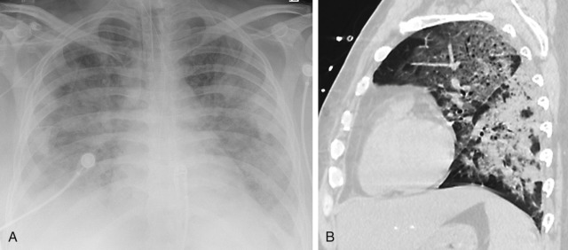 FIGURE 10.13, Acute exudative phase of diffuse alveolar damage (DAD) and acute respiratory distress syndrome (ARDS). A, Frontal radiograph demonstrates bilateral consolidation with a peripheral distribution typical of DAD with ARDS, in this case caused by the H1N1 influenza strain. B, Sagittal contrast-enhanced computed tomography scan from a different patient shows characteristic ventral-dorsal and cephalocaudal gradient of ground-glass opacity and consolidation.