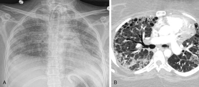 FIGURE 10.14, Chronic or fibrotic phase of diffuse alveolar damage (DAD). A, Frontal radiograph shows diffuse coarse reticular opacities and diminished lung volumes. B, Axial contrast-enhanced computed tomography scan from a different patient demonstrates anterior lung predominance of fibrosis and cysts associated with reticular and ground-glass opacities typical of the chronic phase of DAD.