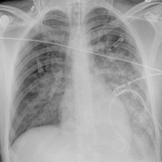 FIGURE 10.2, Aspiration. Frontal chest radiograph shows left greater than right mid and lower lung zone predominant consolidation in a patient with witnessed massive aspiration. The heart borders are sharp, indicating the consolidation is in the lower lobes. Radiographs earlier that day were normal (not shown).