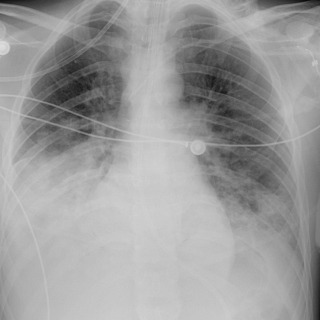 FIGURE 10.3, Ventilator-associated pneumonia. Frontal chest radiograph shows right greater than left mid and lower lung zone consolidation, which developed 3 days after endotracheal tube intubation. There are likely small associated pleural effusions. Haemophilus influenzae was recovered from bronchoalveolar lavage fluid.