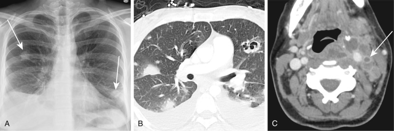 FIGURE 10.4, Septic emboli. A, Frontal chest radiograph demonstrates bilateral nodules (arrows) . B , Contrast-enhanced computed tomography (CECT) confirms peripheral pulmonary nodules of various sizes, including a left upper lobe cavitary nodule. C, CECT of the neck identifies the source of the septic emboli, thrombophlebitis of the left internal jugular vein (Lemierre syndrome) (arrow) with surrounding abscess and effacement of the airway. The cause of the abscess was Fusobacterium necrophorum .