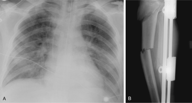 FIGURE 10.5, Fat emboli. A, Frontal chest radiograph obtained 4 days after significant trauma demonstrates patchy bilateral airspace opacities. In contrast to pulmonary contusion, which usually manifests as airspace disease within 24 hours of the inciting trauma, fat embolism syndrome has a lag in the radiographic appearance of opacities. Note absent pleural effusions, which helps differentiate from cardiogenic pulmonary edema. B, Lower extremity radiograph confirms comminuted fractures involving the tibia and fibula.