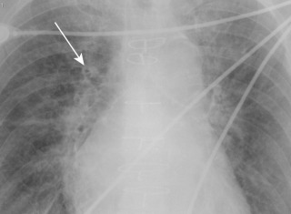 FIGURE 10.6, Cardiogenic interstitial pulmonary edema. Coned frontal radiograph reveals peribronchial cuffing (arrow) and indistinct perihilar vessels in a patient with interstitial pulmonary edema.