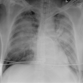 FIGURE 10.8, Cardiogenic alveolar pulmonary edema. Frontal radiograph demonstrates a bat-wing pattern of perihilar consolidation surrounded by a radiolucent peripheral zone of normal lung in keeping with alveolar pulmonary edema in a patient with acute myocardial infarction.