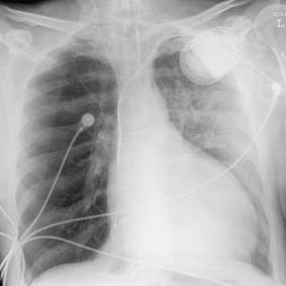 FIGURE 10.10, Asymmetric pulmonary edema. Frontal chest radiograph demonstrates hyperlucency of the right lung caused by severe emphysema, with asymmetric pulmonary edema in the less affected left lung.