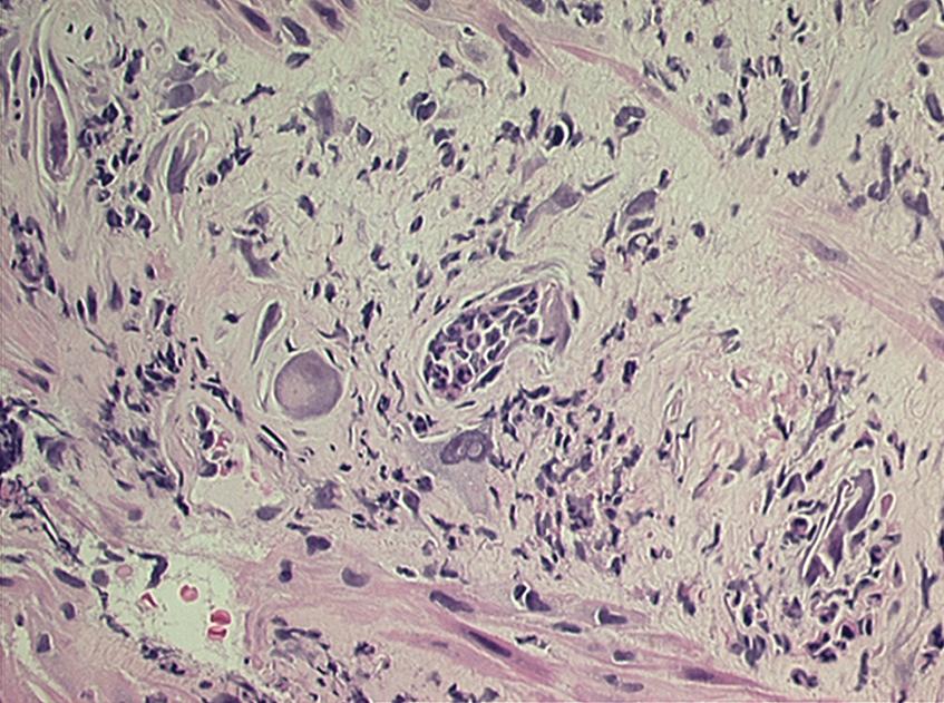 Fig. 41.1, Histopathology showing microabscesses and radiation-related fibroblasts. Submucosal reaction shows large, bizarre radiation fibroblasts that have both cytomegaly and nucleomegaly. Smooth muscle cells also have reactive changes. Microabscesses composed of excess neutrophils infiltrate the stroma.