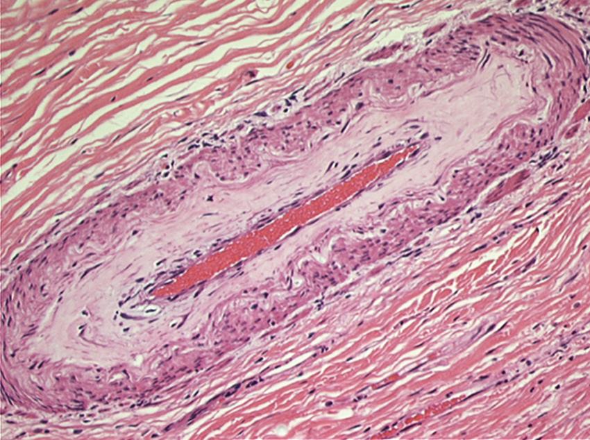 Fig. 41.2, Histopathology showing a submucosal arteriole in chronic radiation enteropathy. Radiation-induced changes include thickening of the blood vessel walls, subintimal hydropic change and fibrosis, which results in luminal narrowing and occlusion and subsequent tissue ischemia.