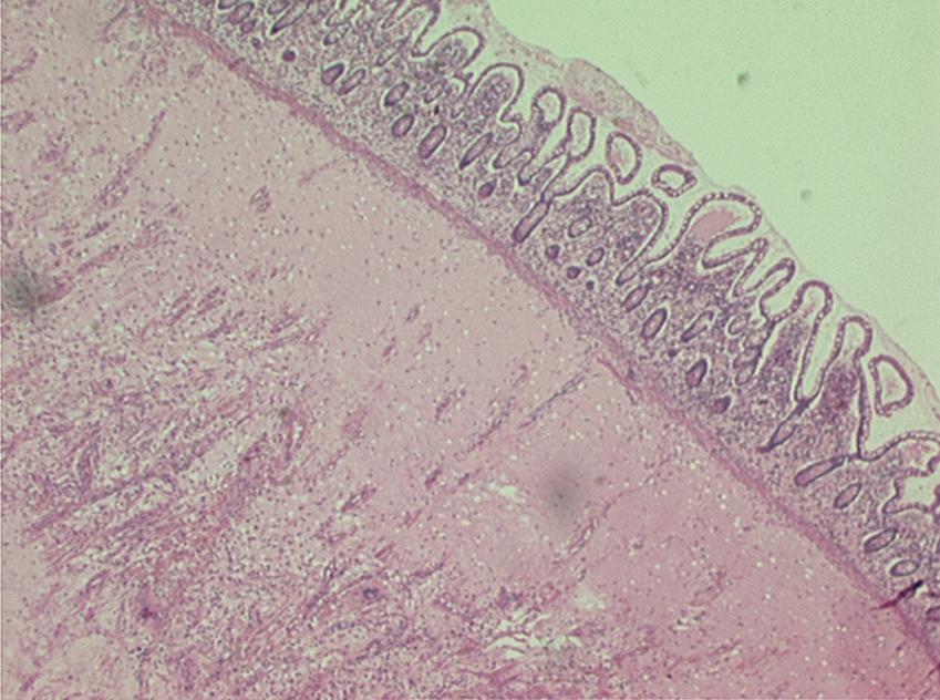 Fig. 41.3, Histopathology showing small intestinal submucosal fibrosis following radiation therapy. The patient presented with small intestinal obstruction due to this stricture.