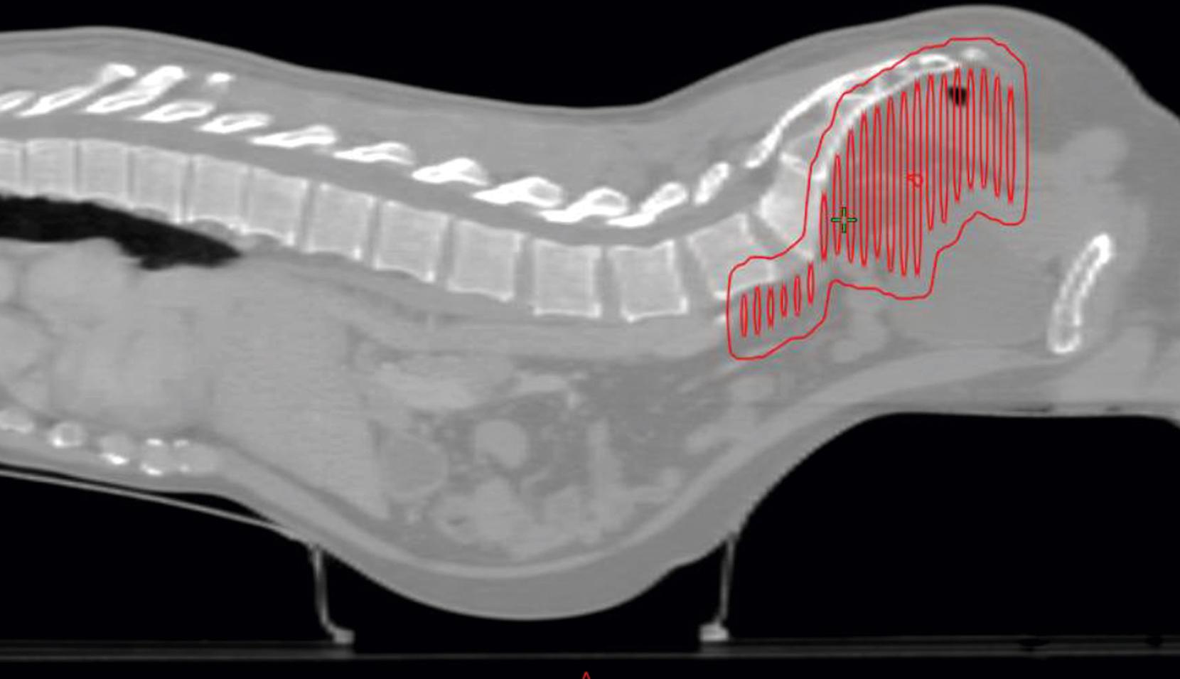 Fig. 41.4, Image from a planning scan performed on a patient with rectal cancer. The patient was positioned prone on a belly board, which allows the small bowel to fall out of the anatomic area to which the prescription dose is planned (illustrated in red).