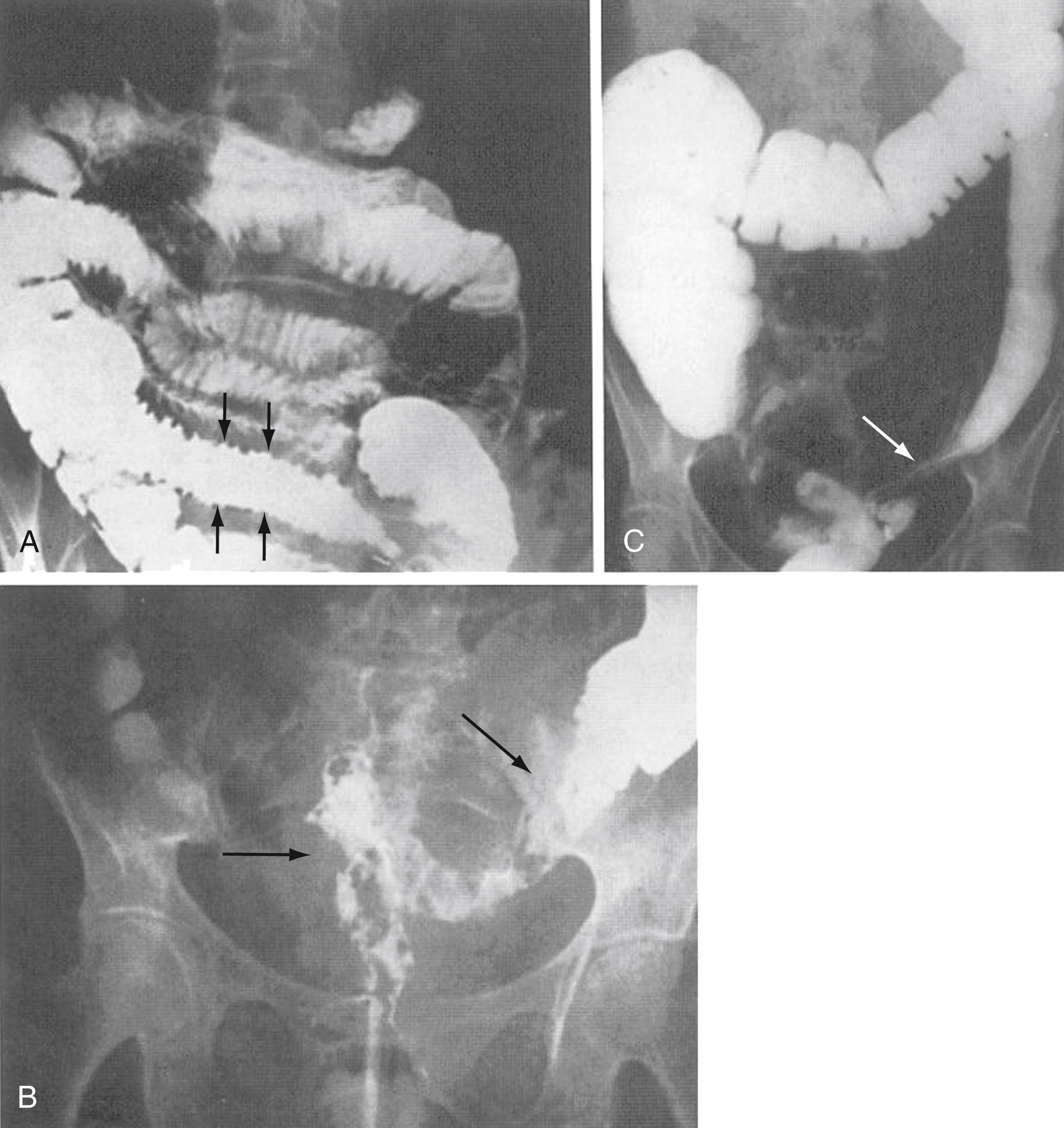 Fig. 41.5, Radiologic evidence of radiation injury of the intestine. A, In early injury, bowel and mesenteric edema may cause separation of intestinal loops, lead to thickening and straightening of mucosal folds, and impart a spiked appearance ( arrows ) to the small bowel mucosa. B, Severe abnormalities of the rectosigmoid colon are evident on this film from a barium enema performed 2 months after the patient underwent radiation therapy for cervical carcinoma. Subacute radiation injury of the colon may present as edematous, occasionally ulcerated mucosa with asymmetrical areas of narrowing suggestive of Crohn colitis or recurrent tumor ( arrows ). C, Late radiation change in the colon, with stricture formation ( arrow ) after a cumulative dose of approximately 55 Gy.