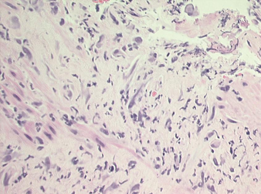 Fig. 41.6, Histopathology of acute radiation-induced esophageal injury showing esophageal ulceration with abundant fibroblasts.