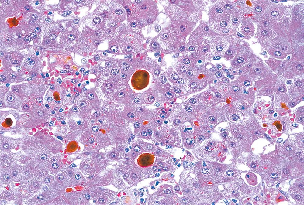 FIGURE 47.2, Acute viral hepatitis.