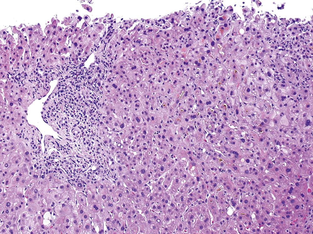 FIGURE 47.3, Cholestatic hepatitis.