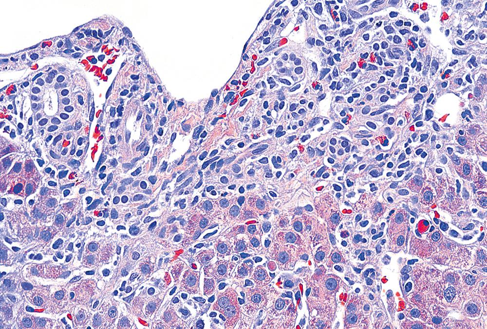 FIGURE 47.4, Acute viral hepatitis.