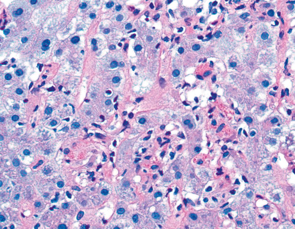 FIGURE 47.5, Periodic acid–Schiff staining after diastase digestion highlights Kupffer cell hyperplasia and the accumulation of phagocytized debris.