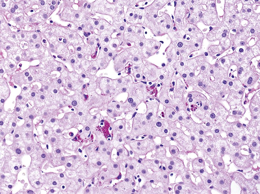 FIGURE 47.6, Periodic acid–Schiff staining after diastase digestion highlights Kupffer cells in deep magenta; they are in areas that used to be occupied by hepatocytes. The Kupffer cells have phagocytized cellular remnants of necrotic hepatocytes. As biopsies may be taken some time after the liver injury, biopsies accompanied by histories of recent markedly elevated liver chemistries may appear nearly normal but have these debris-laden Kupffer cells to indicate there is resolving acute hepatitis.