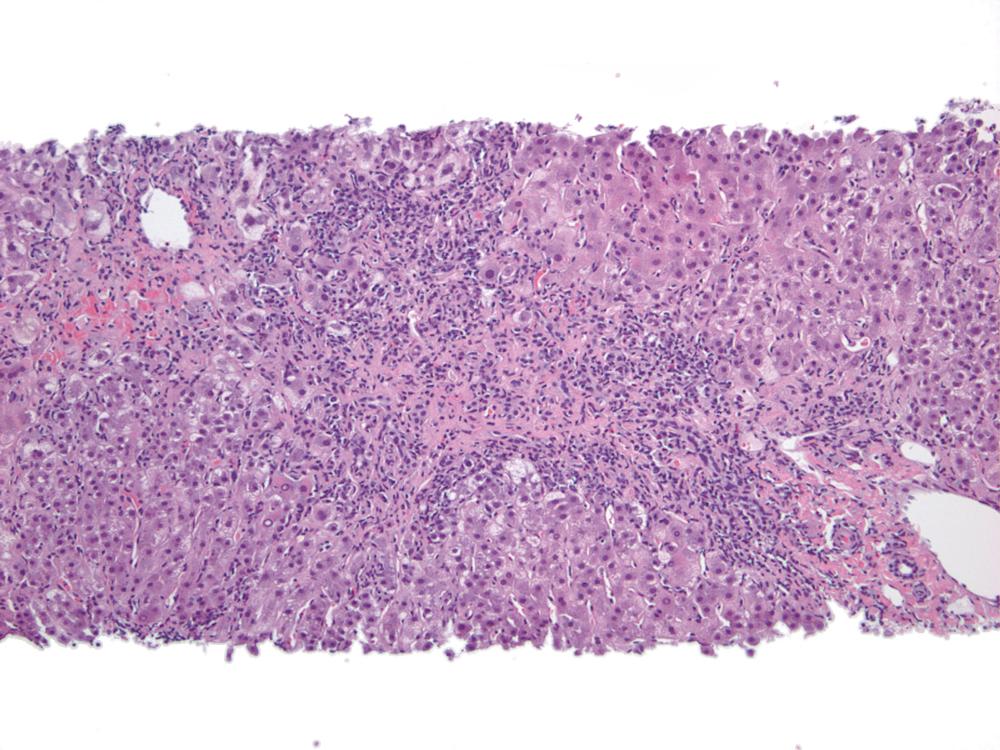 FIGURE 47.7, Bridging necrosis.