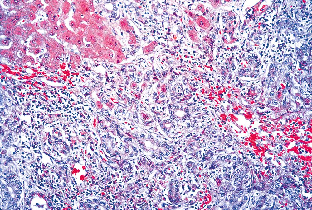 FIGURE 47.8, Acute viral hepatitis.