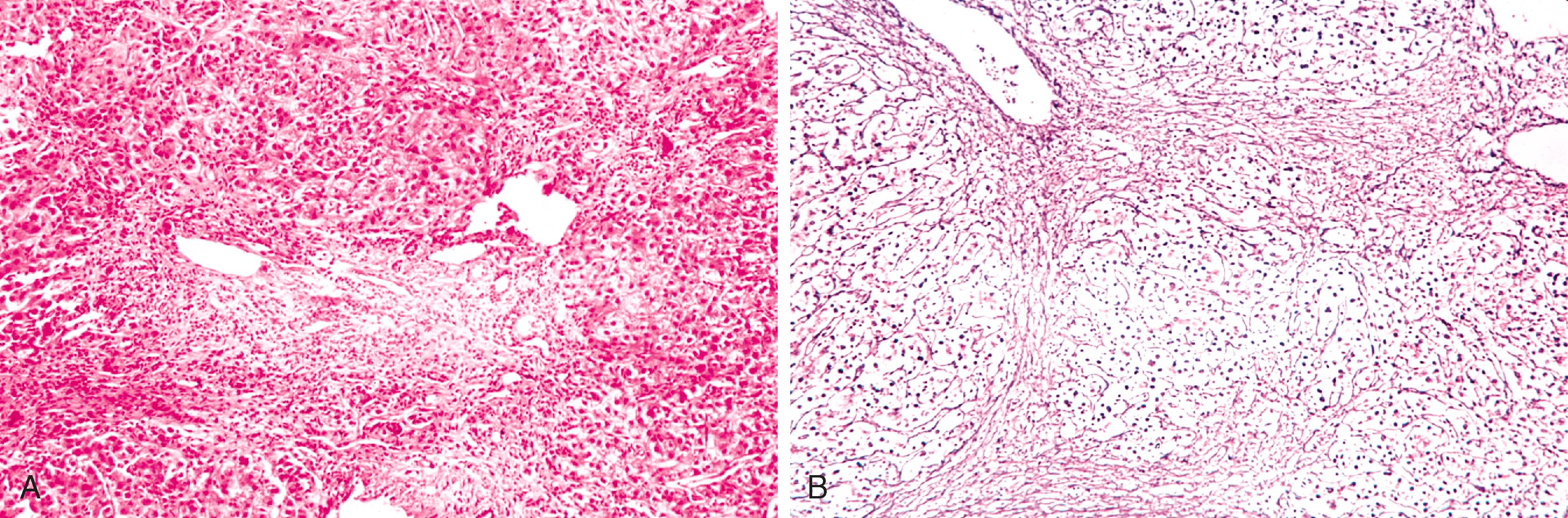 FIGURE 47.9, A, Hematoxylin and eosin section of an area of lobular necrosis from a patient with acute liver failure. B, Trichrome stain is pale blue in the areas of hepatocyte loss, compared with the darker blue of the collagen around the portal tract.