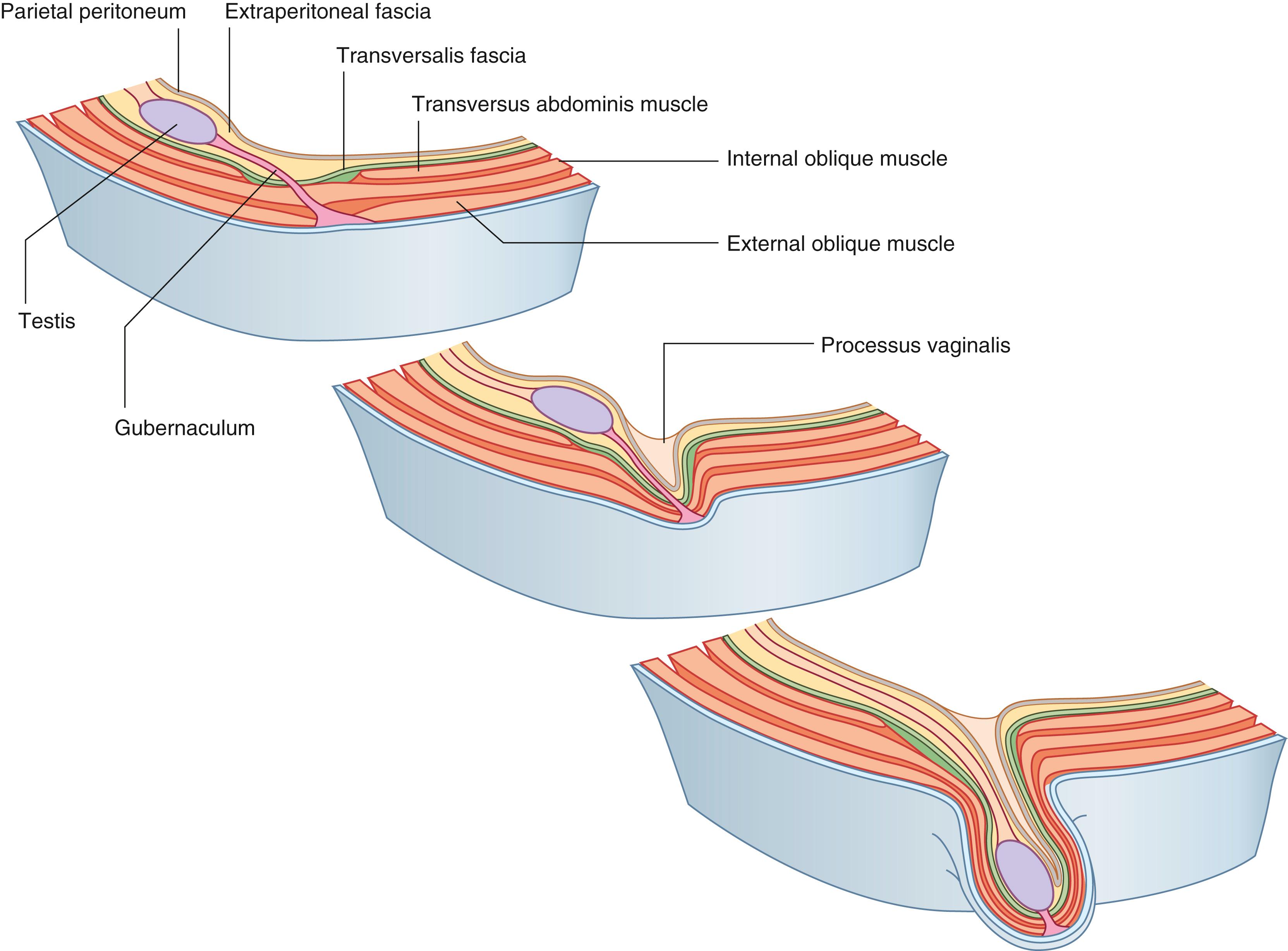 Fig. 24.1, Descent of the testis from week 7 (postfertilization) to birth. As the testis and spermatic cord descend through the inguinal canal, they are covered by the three concentric layers of the anterior abdominal fascia.